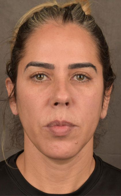 Facelift Before & After Patient #2883