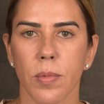 Facelift Before & After Patient #2883