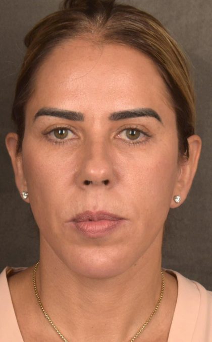 Facelift Before & After Patient #2883