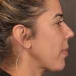 Facelift Before & After Patient #2883