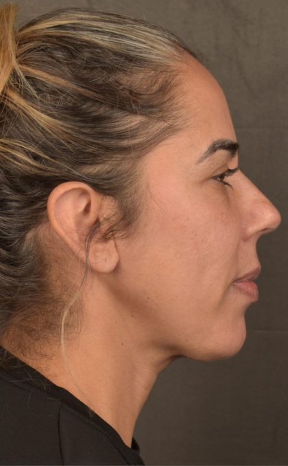 Facelift Before & After Patient #2883