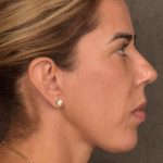 Facelift Before & After Patient #2883