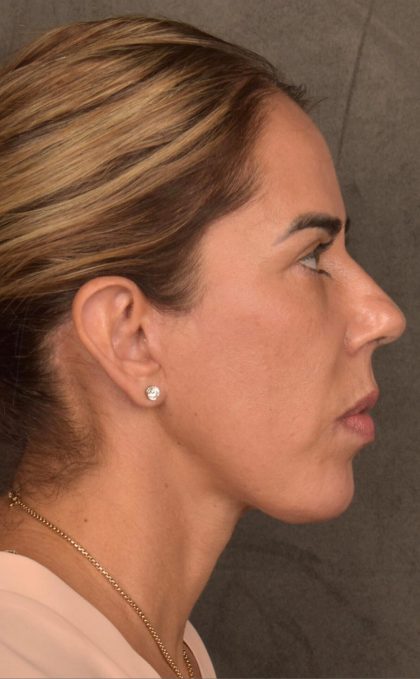 Facelift Before & After Patient #2883