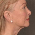 Facelift Before & After Patient #2867