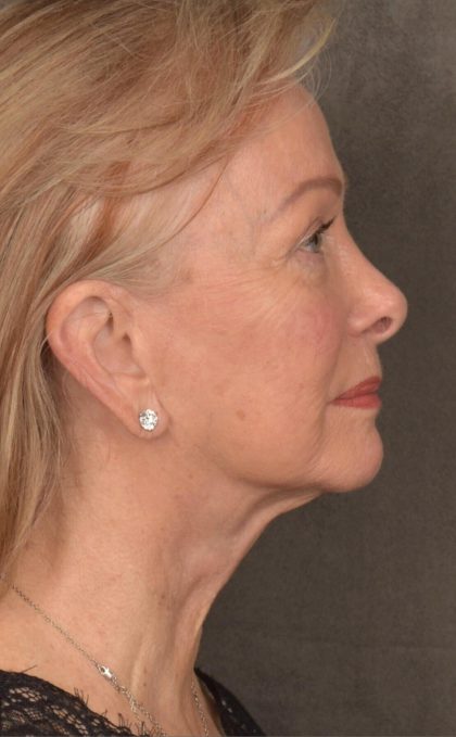 Facelift Before & After Patient #2867