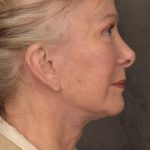 Facelift Before & After Patient #2867