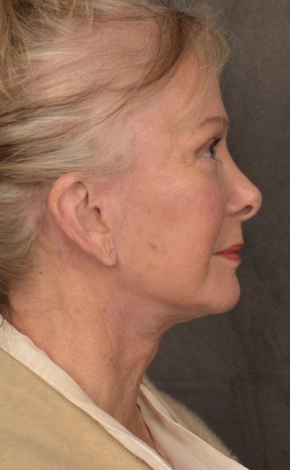 Facelift Before & After Patient #2867