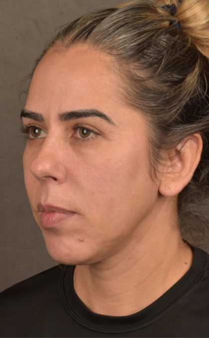 Facelift Before & After Patient #2883