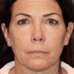 Facelift Before & After Patient #2884