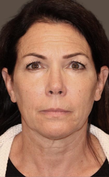 Facelift Before & After Patient #2884