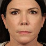 Facelift Before & After Patient #2884