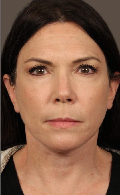 Facelift Before & After Patient #2884