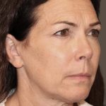 Facelift Before & After Patient #2884