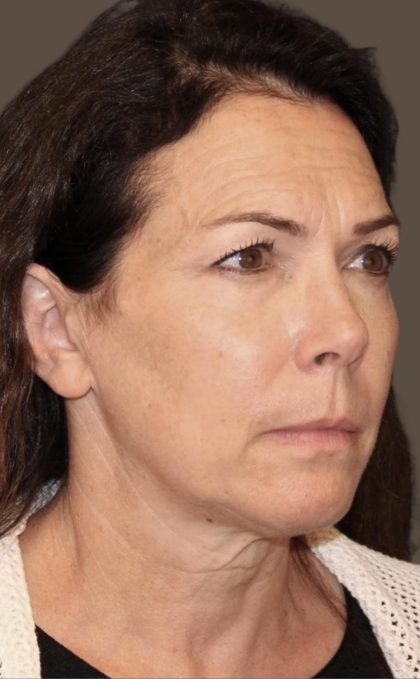 Facelift Before & After Patient #2884