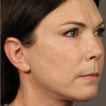 Facelift Before & After Patient #2884