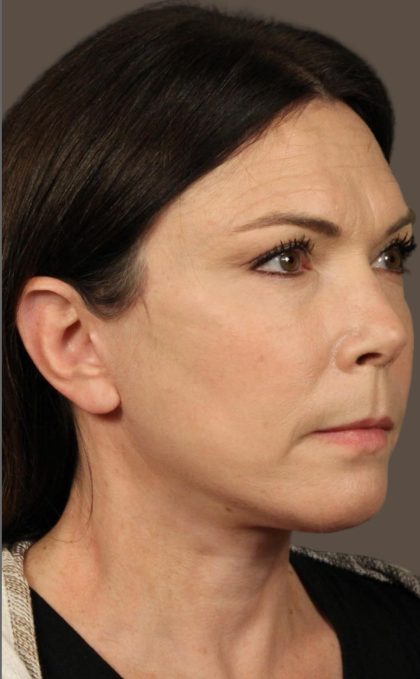 Facelift Before & After Patient #2884