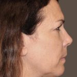 Facelift Before & After Patient #2884