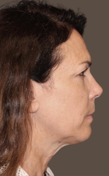 Facelift Before & After Patient #2884