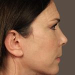 Facelift Before & After Patient #2884