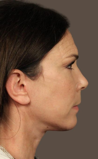 Facelift Before & After Patient #2884
