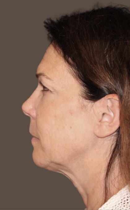 Facelift Before & After Patient #2884