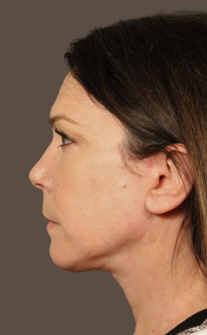 Facelift Before & After Patient #2884