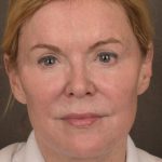 Facelift Before & After Patient #2885