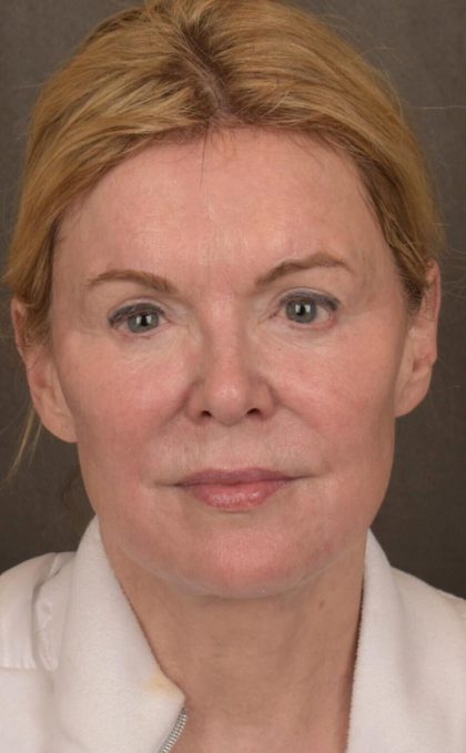 Facelift Before & After Patient #2885
