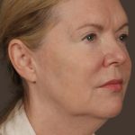 Facelift Before & After Patient #2885