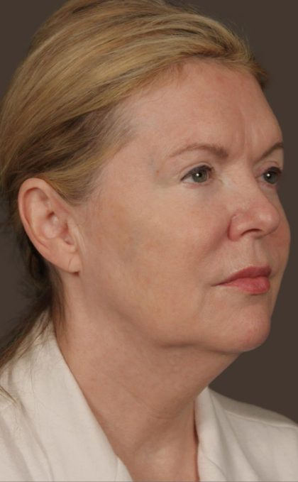Facelift Before & After Patient #2885