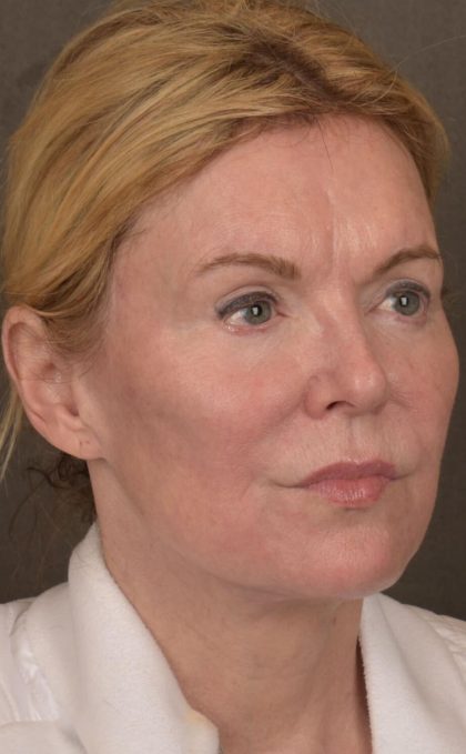 Facelift Before & After Patient #2885