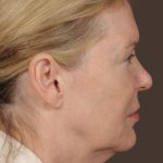 Facelift Before & After Patient #2885