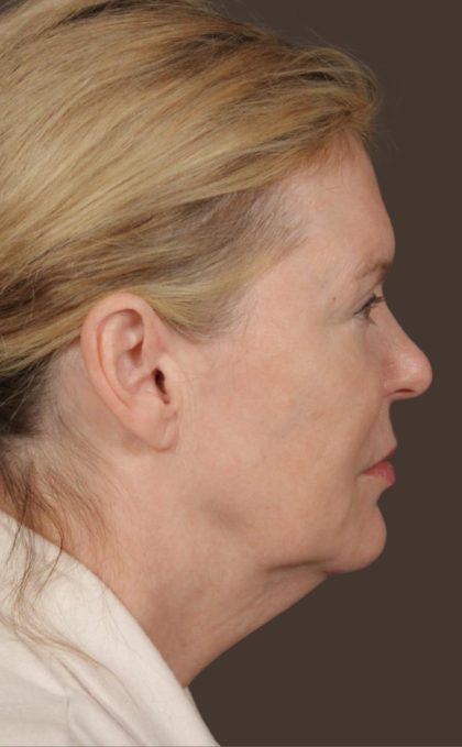 Facelift Before & After Patient #2885
