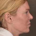 Facelift Before & After Patient #2885