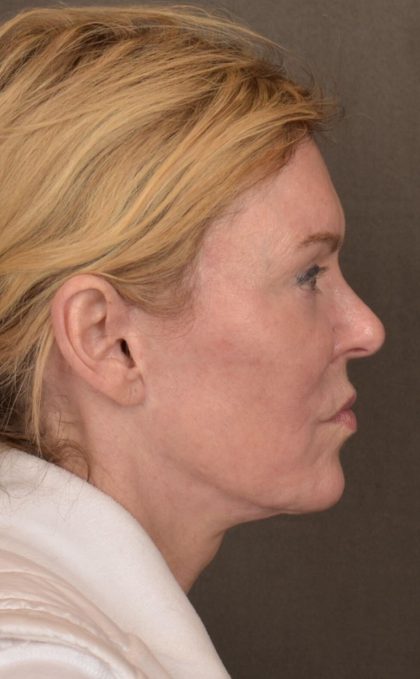Facelift Before & After Patient #2885