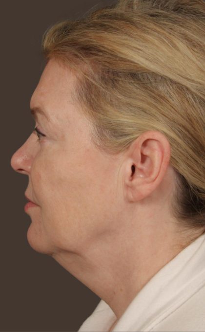 Facelift Before & After Patient #2885