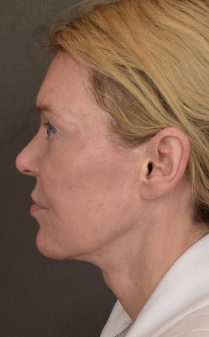 Facelift Before & After Patient #2885