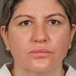 Facelift Before & After Patient #2886