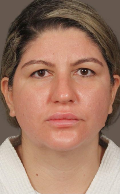 Facelift Before & After Patient #2886