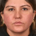 Facelift Before & After Patient #2886
