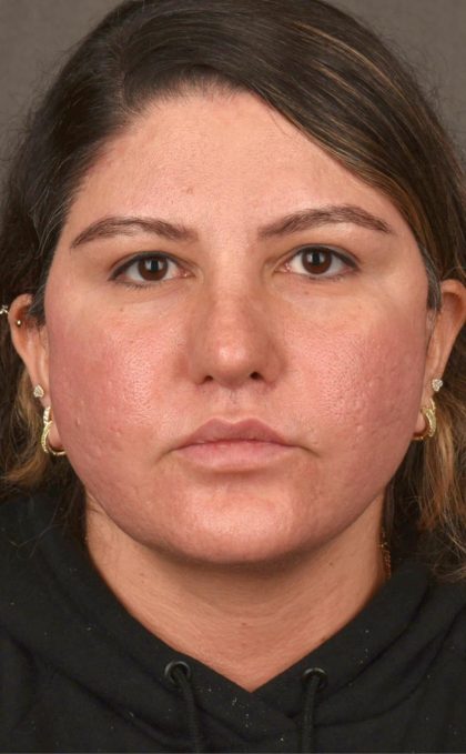 Facelift Before & After Patient #2886