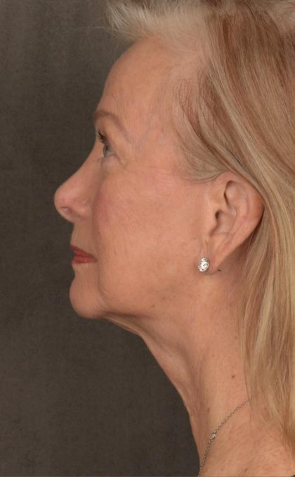 Facelift Before & After Patient #2867