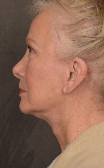 Facelift Before & After Patient #2867