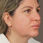 Facelift Before & After Patient #2886