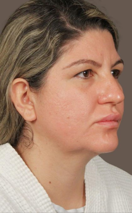 Facelift Before & After Patient #2886