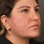 Facelift Before & After Patient #2886