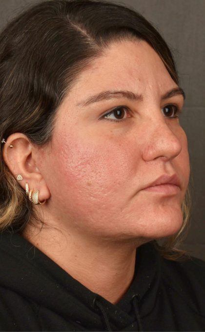 Facelift Before & After Patient #2886