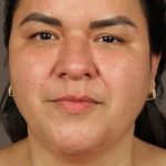 Facelift Before & After Patient #2887