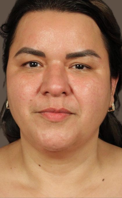 Facelift Before & After Patient #2887