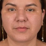 Facelift Before & After Patient #2887